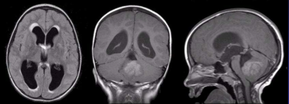 MVH Med Staff CME Library- Diagnosis and Treatment of Adult Brain Tumors – (Everything you always wanted to know but were afraid to ask) presented by Dr. Andrew Sloan Banner